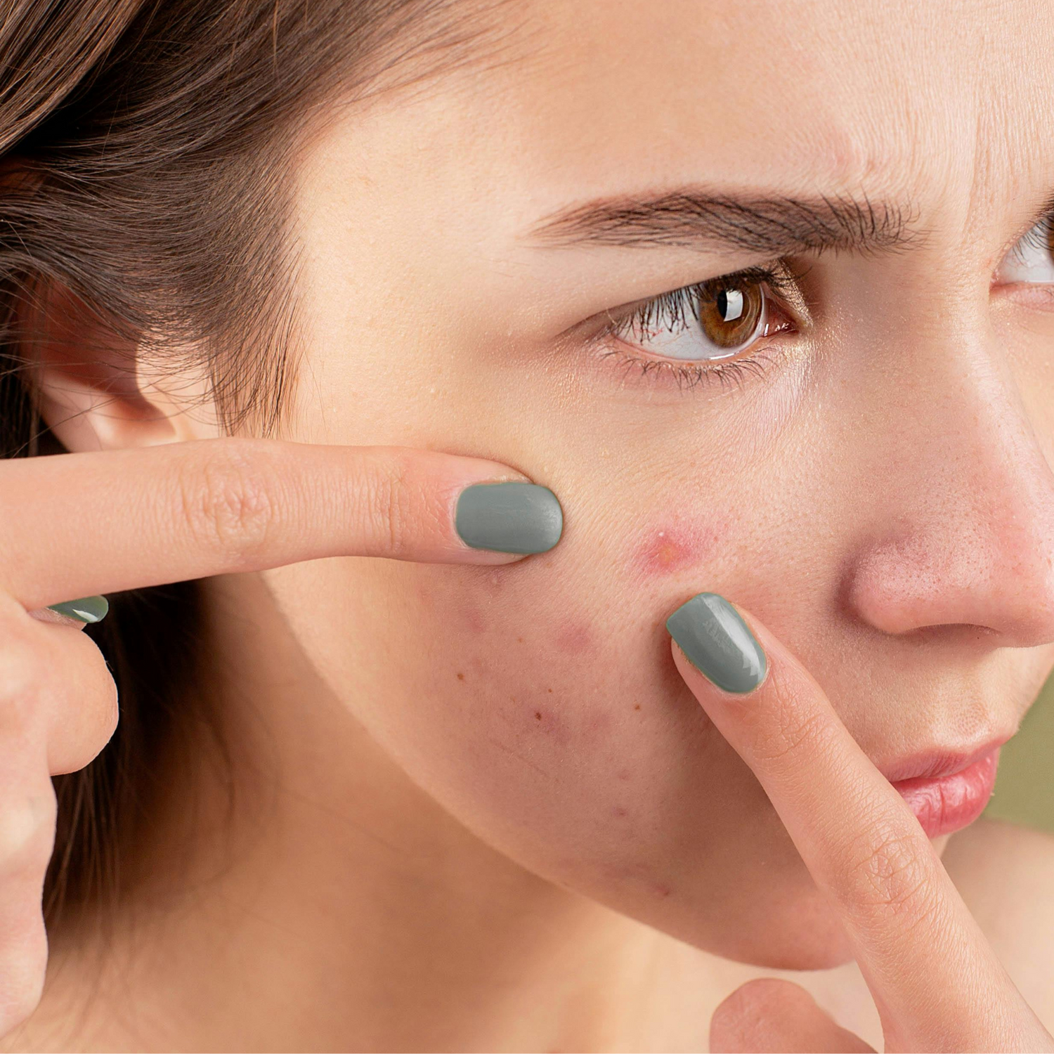 Acne, Eczema, Psoriasis